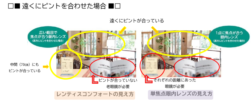 レンティスコンフォート（低加入度数分節型眼内レンズ）保険適応