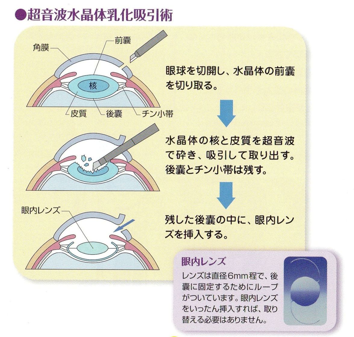 手術 運転 白内障 後