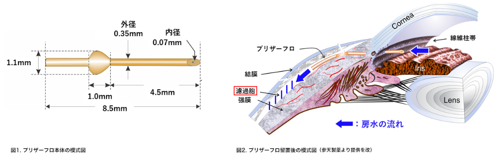 手術の方法 図1. プリザーフロ本体の模式図 図2. プリザーフロ留置後の模式図 （参天製薬より提供を改）