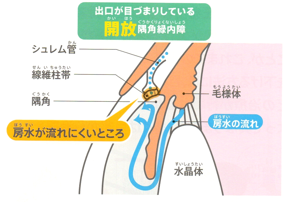 開放隅角緑内障・閉塞隅角緑内障とは