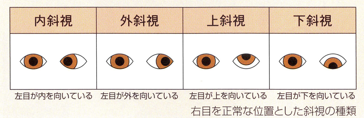 斜視の種類