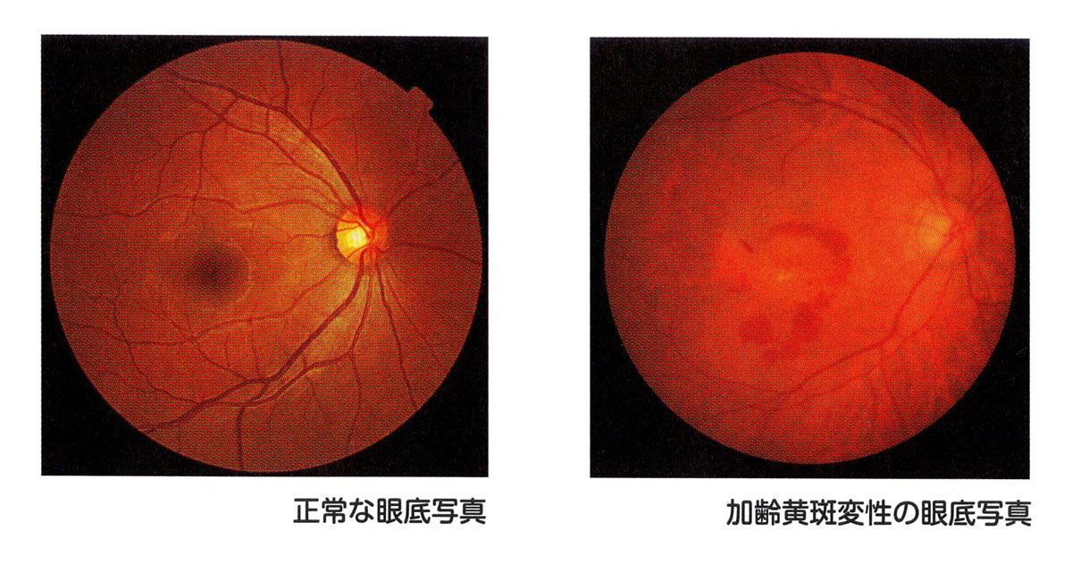 加齢黄斑変性症