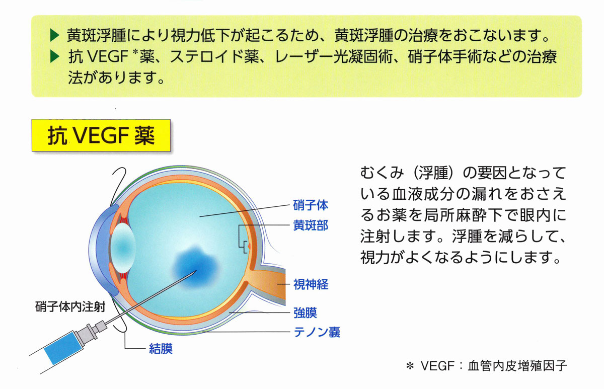 注射 症 黄斑 変性
